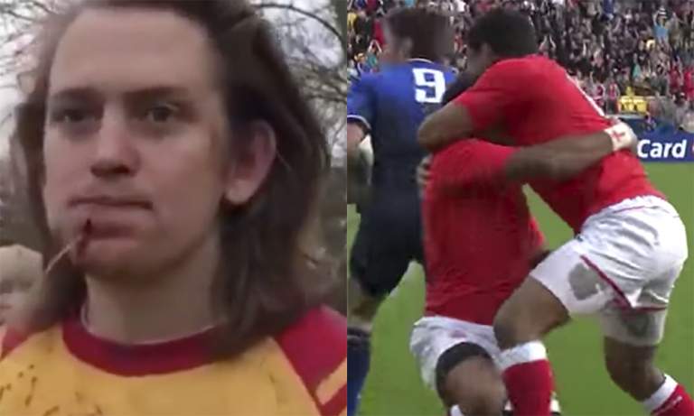 Rugbypelaajan kasvoissa karmiva reikä. Rugbyn ykkösdivisioonajoukkue Medway RFC julkaisi Twitterissä videon pelottavasta tilanteesta.